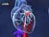 catheter heart